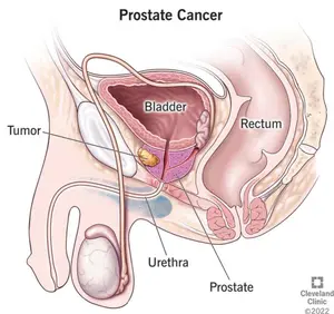 Dr. Peter Attia says prostate cancer is preventable. Find out how to test for it.