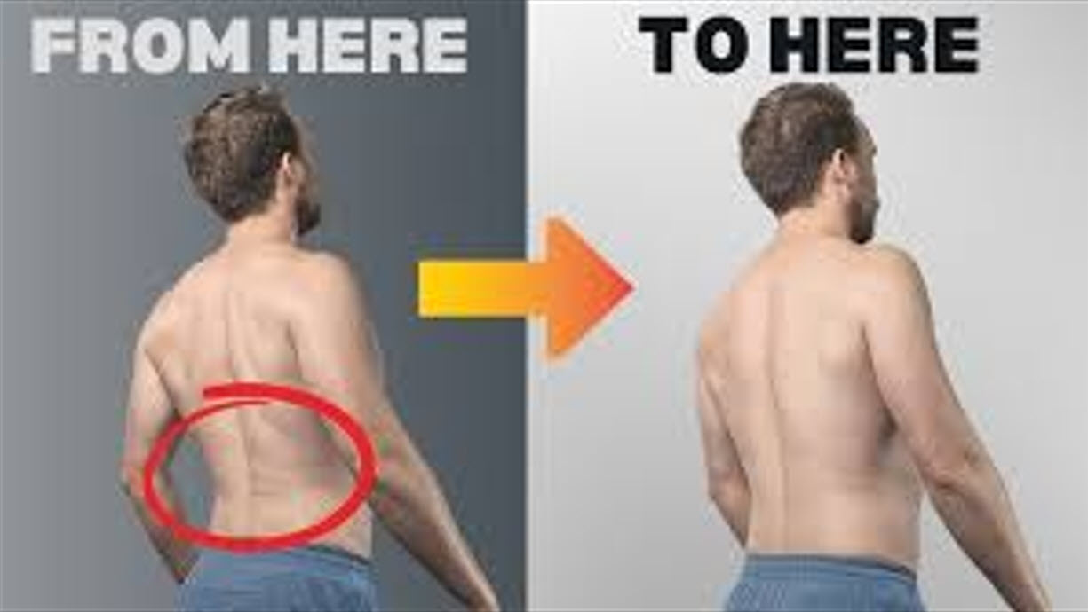 hyperextension hyperextension