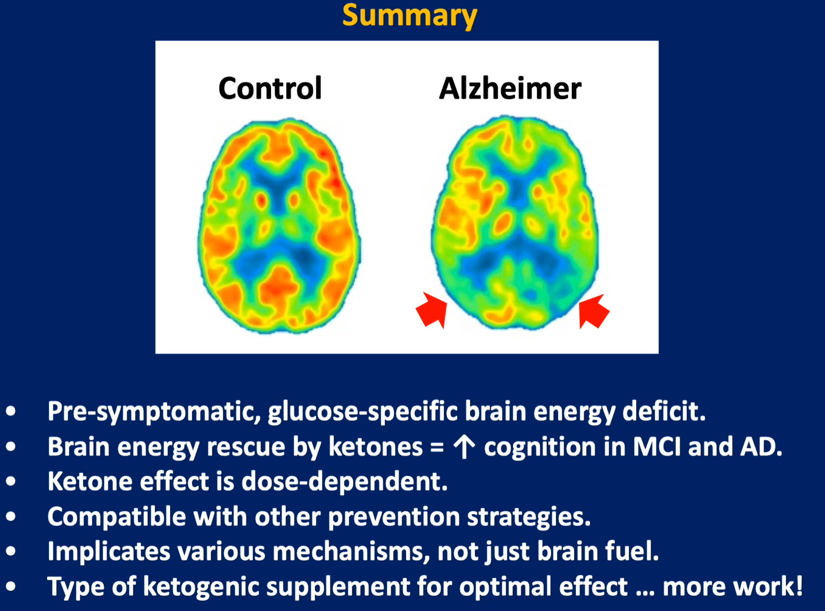 ketones Alzheimer's brain scan