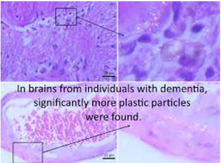 microplastics in demented brain