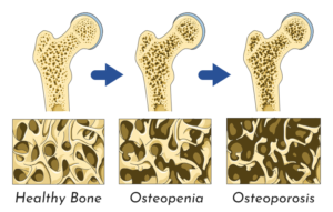 osteopenia