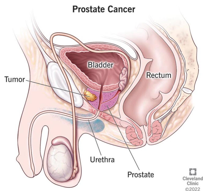 prostate cancer