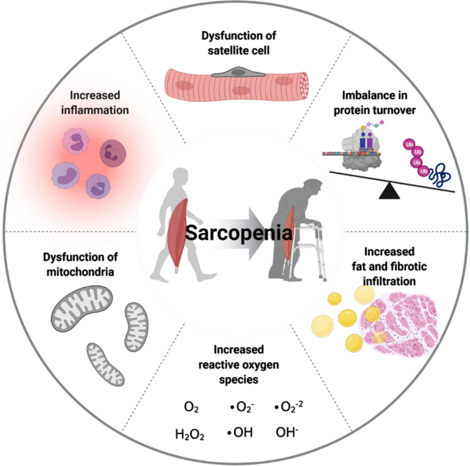 Sarcopenia Sarcopenia
